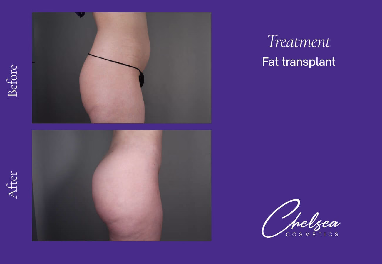 Fat-Transplant-6-3 — Chelsea Cosmetics Melbourne