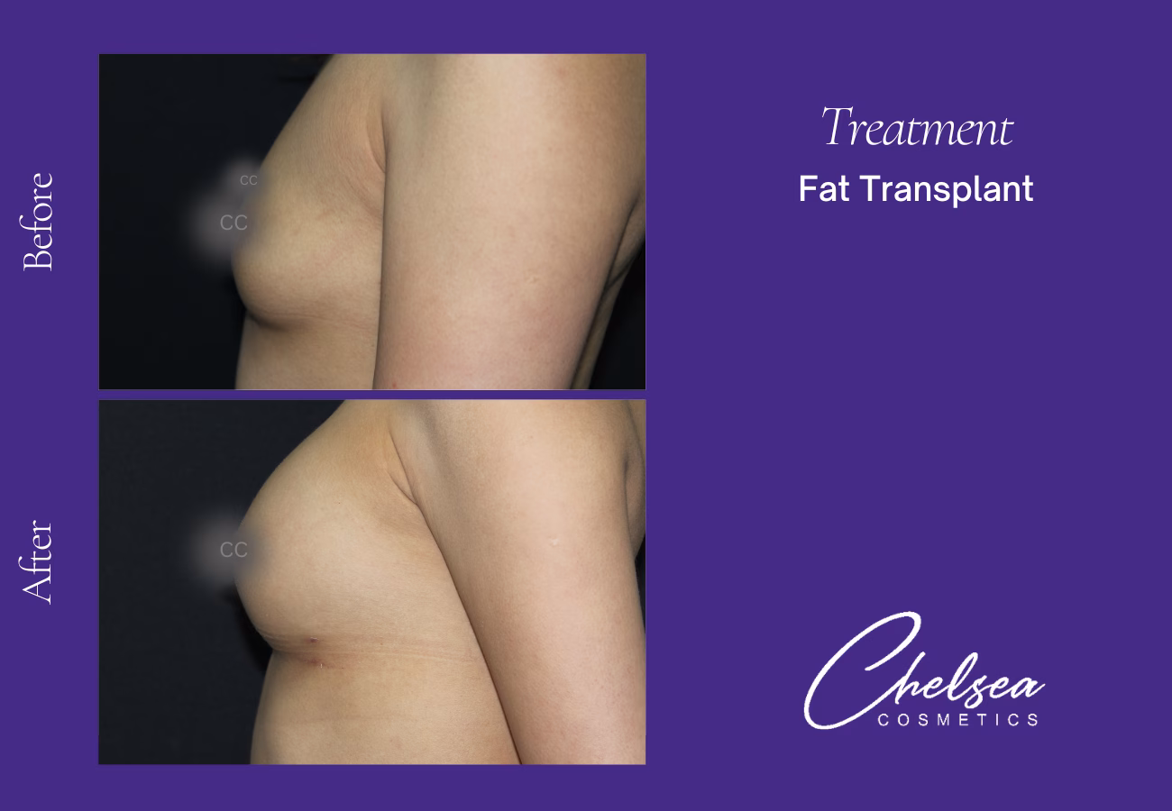 Fat transplant — Chelsea Cosmetics Melbourne