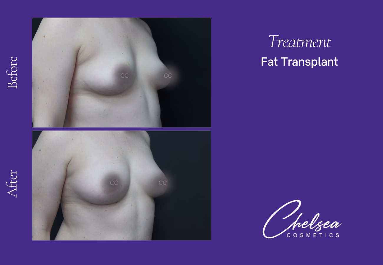 Fat transplant — Chelsea Cosmetics Melbourne