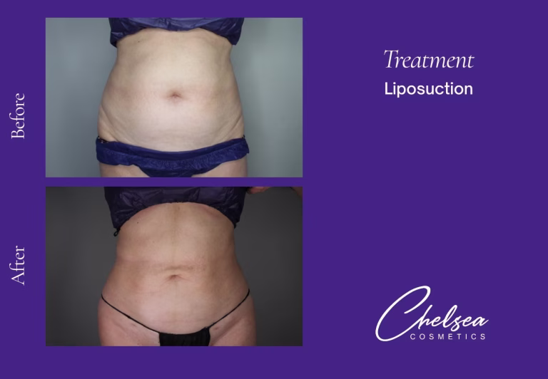 Liposuction — Chelsea Cosmetics Melbourne