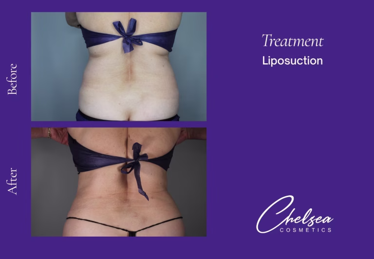 Liposuction before and after results — Chelsea Cosmetics Melbourne