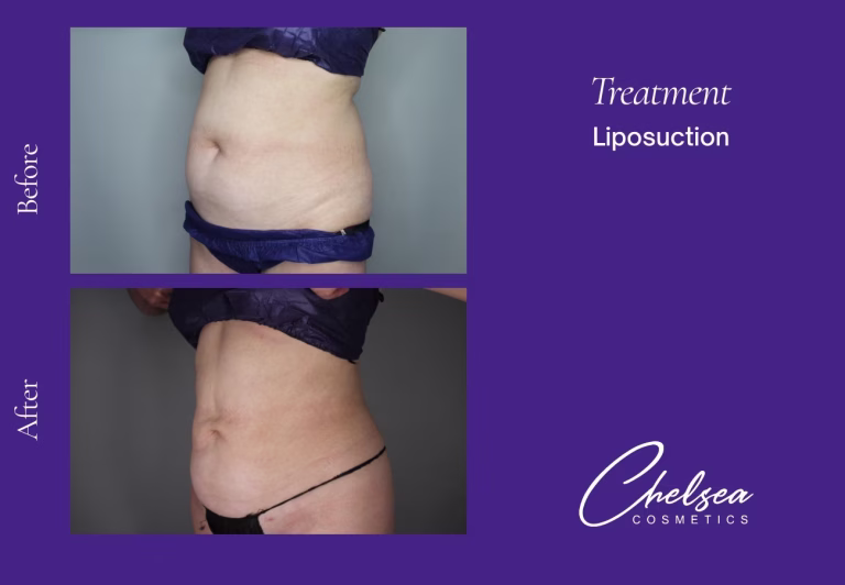 Liposuction — Chelsea Cosmetics Melbourne