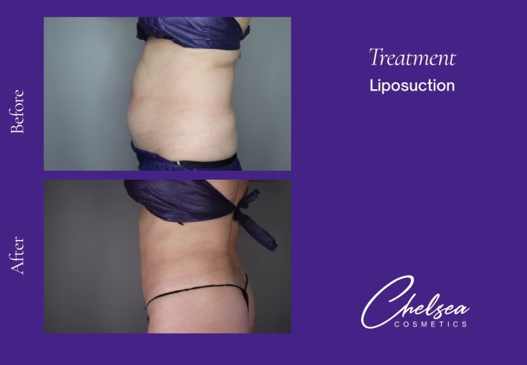 Liposuction — Chelsea Cosmetics Melbourne