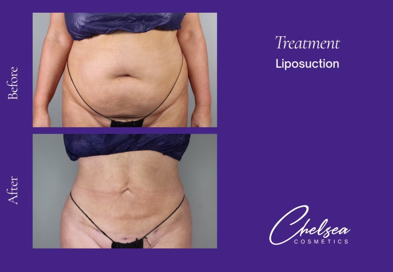 Liposuction — Chelsea Cosmetics Melbourne