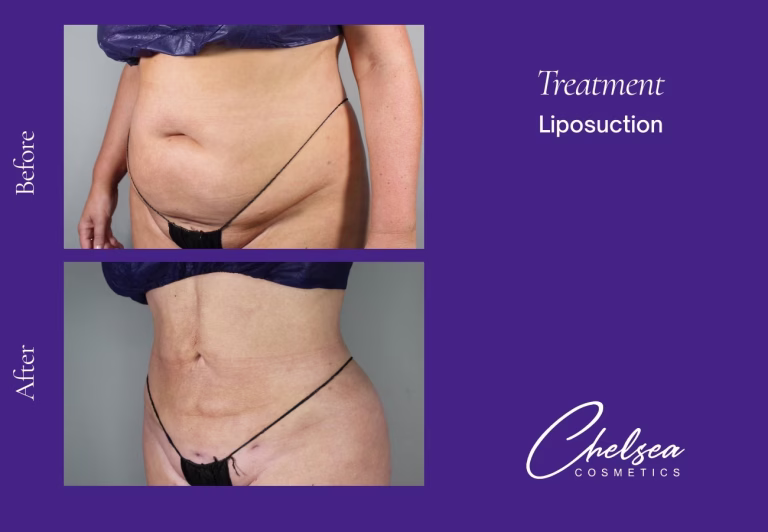 Liposuction — Chelsea Cosmetics Melbourne