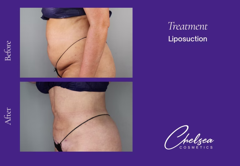 Liposuction — Chelsea Cosmetics Melbourne