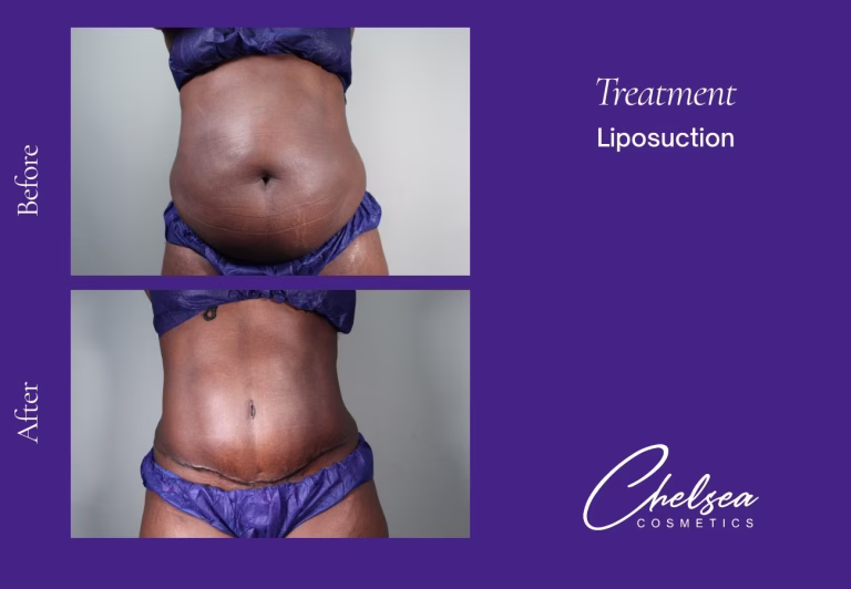 Liposuction — Chelsea Cosmetics Melbourne