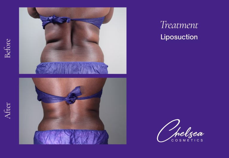 Liposuction before and after results — Chelsea Cosmetics Melbourne