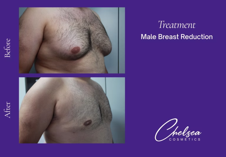 Male Breast Reduction