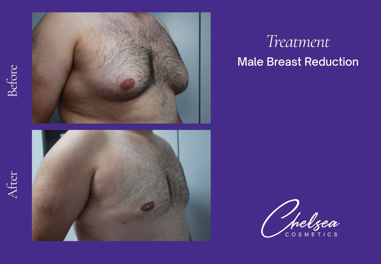 Gynaecomastia Surgery — Chelsea Cosmetics Melbourne