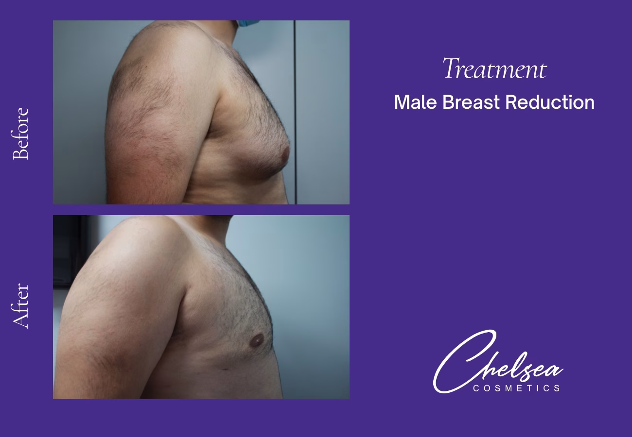 Gynaecomastia Surgery — Chelsea Cosmetics Melbourne