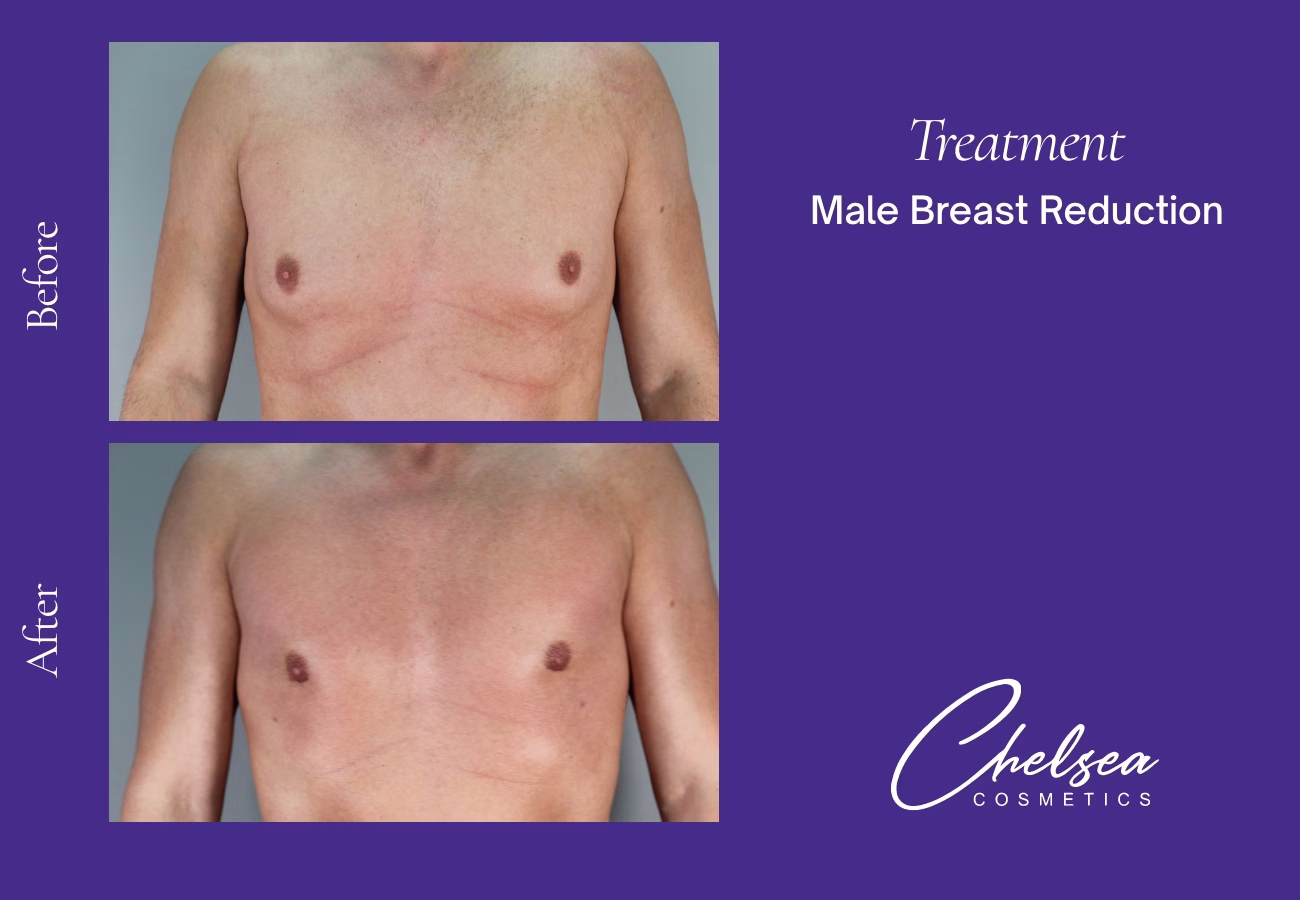 Gynaecomastia Surgery — Chelsea Cosmetics Melbourne