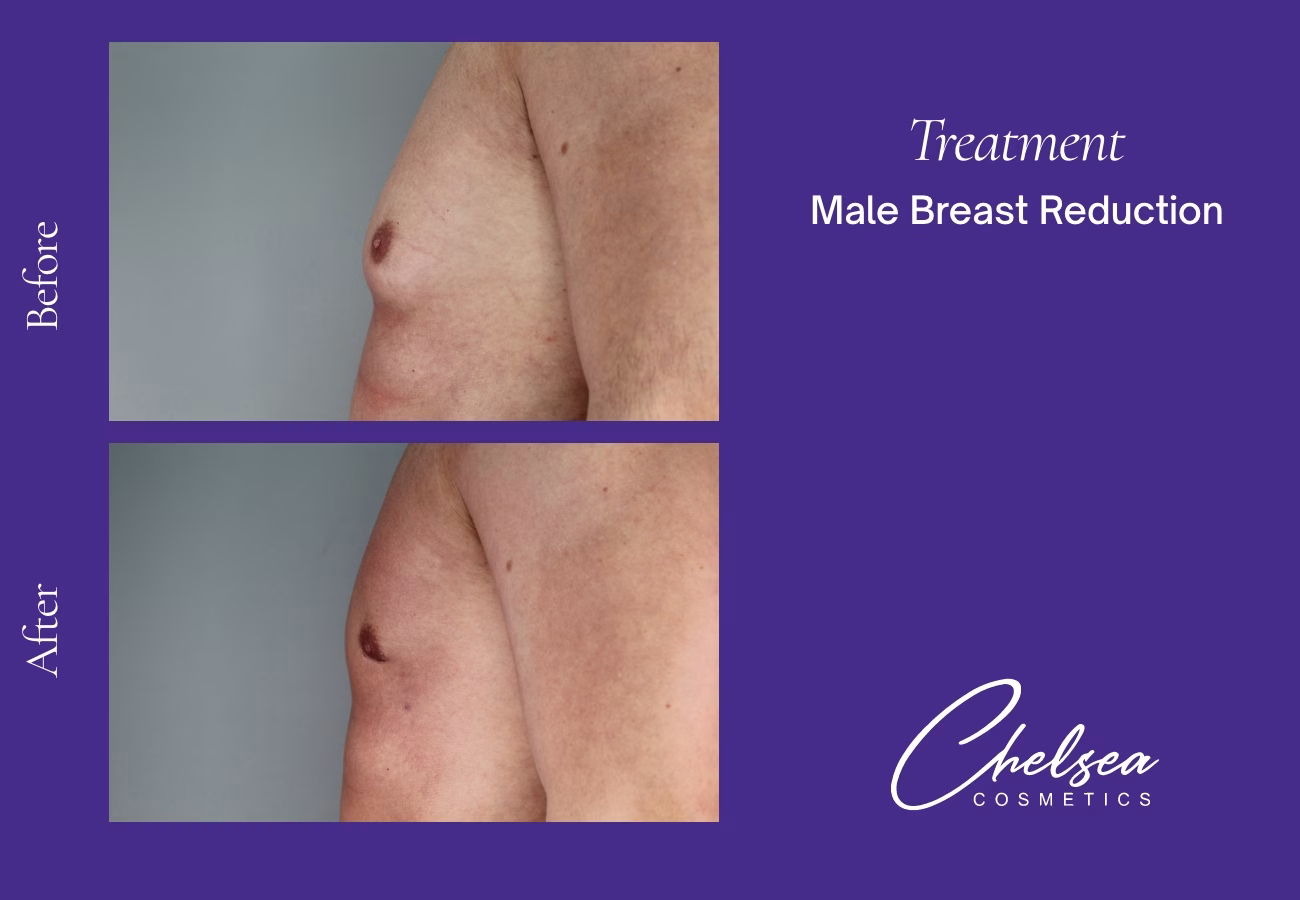 Gynaecomastia Surgery — Chelsea Cosmetics Melbourne