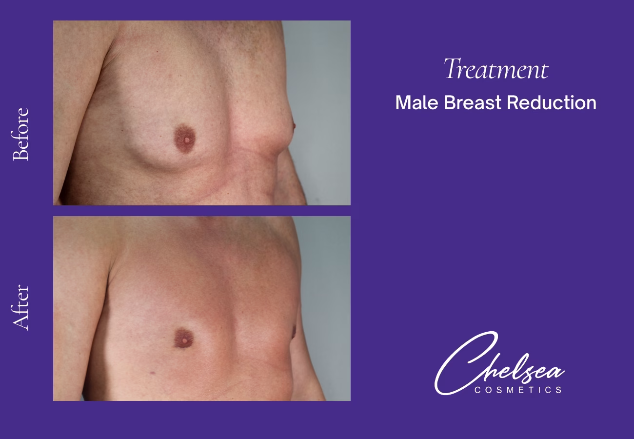 Gynaecomastia Surgery — Chelsea Cosmetics Melbourne
