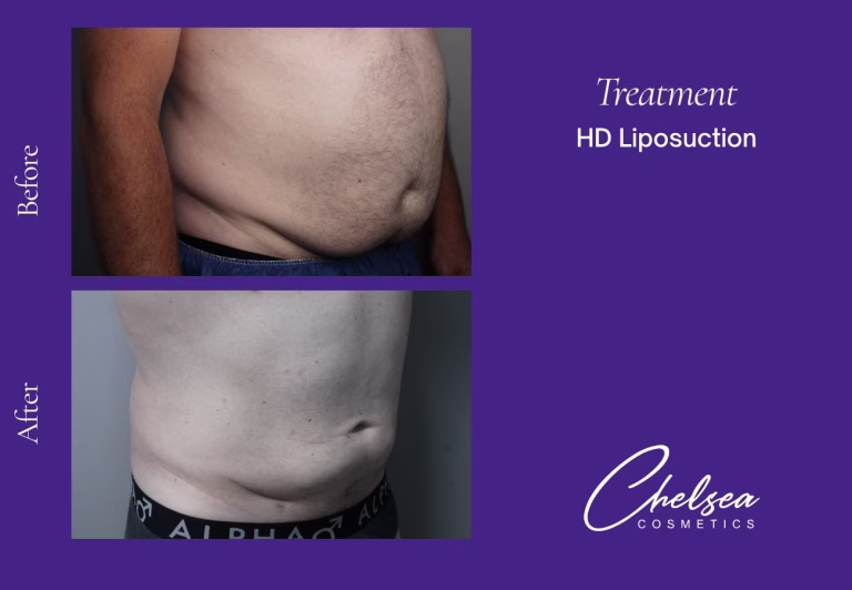 Hd abdomen — Chelsea Cosmetics Melbourne