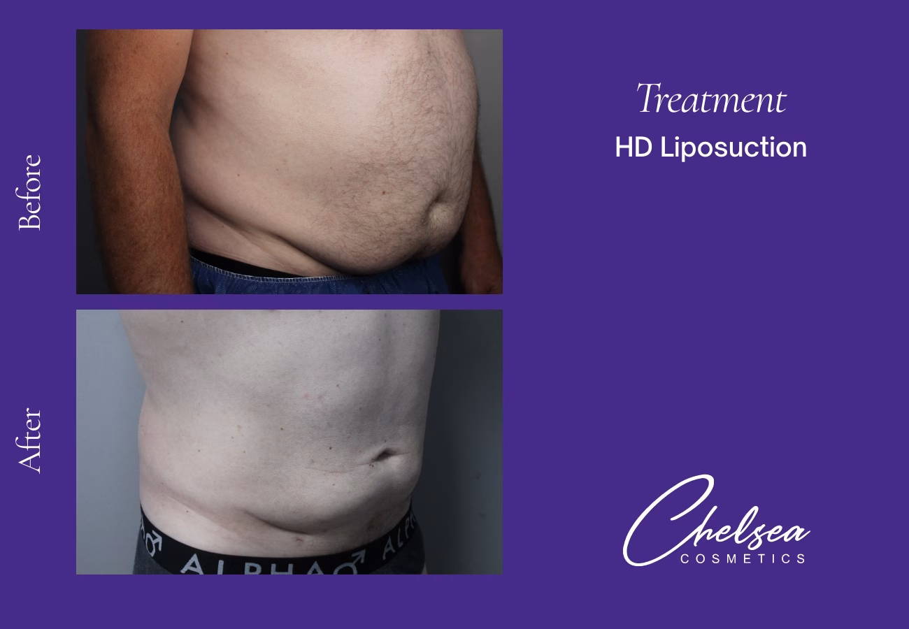 Hd abdomen — Chelsea Cosmetics Melbourne