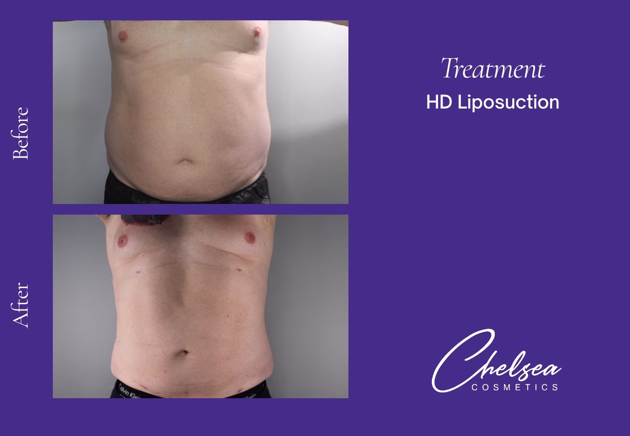 HD-Abdomen-2-Front — Chelsea Cosmetics Melbourne