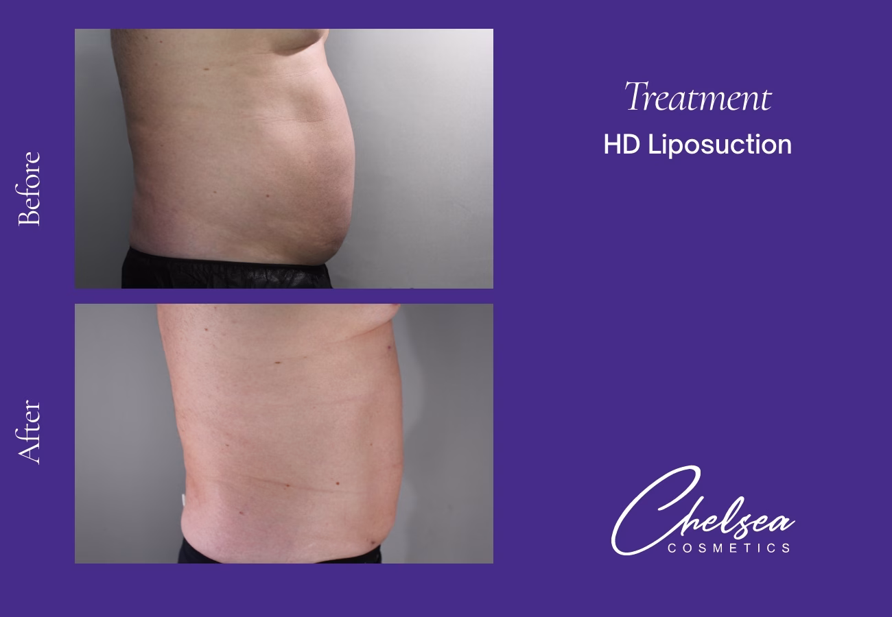 HD-Abdomen-2-Right — Chelsea Cosmetics Melbourne