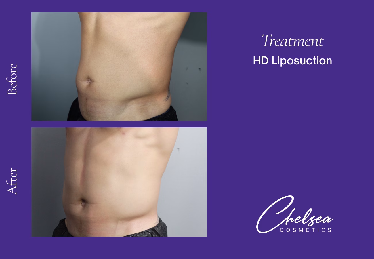 Hd abdomen — Chelsea Cosmetics Melbourne