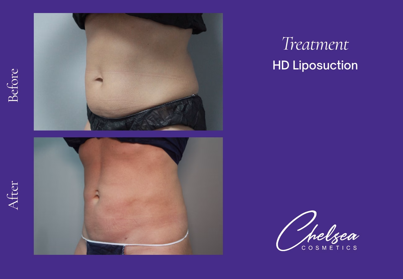 HD-Abdomen-Female-1-Left — Chelsea Cosmetics Melbourne