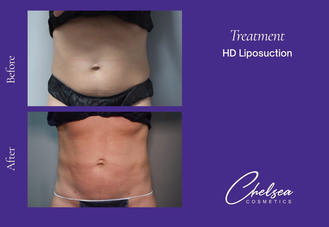 Hd abdomen female — Chelsea Cosmetics Melbourne