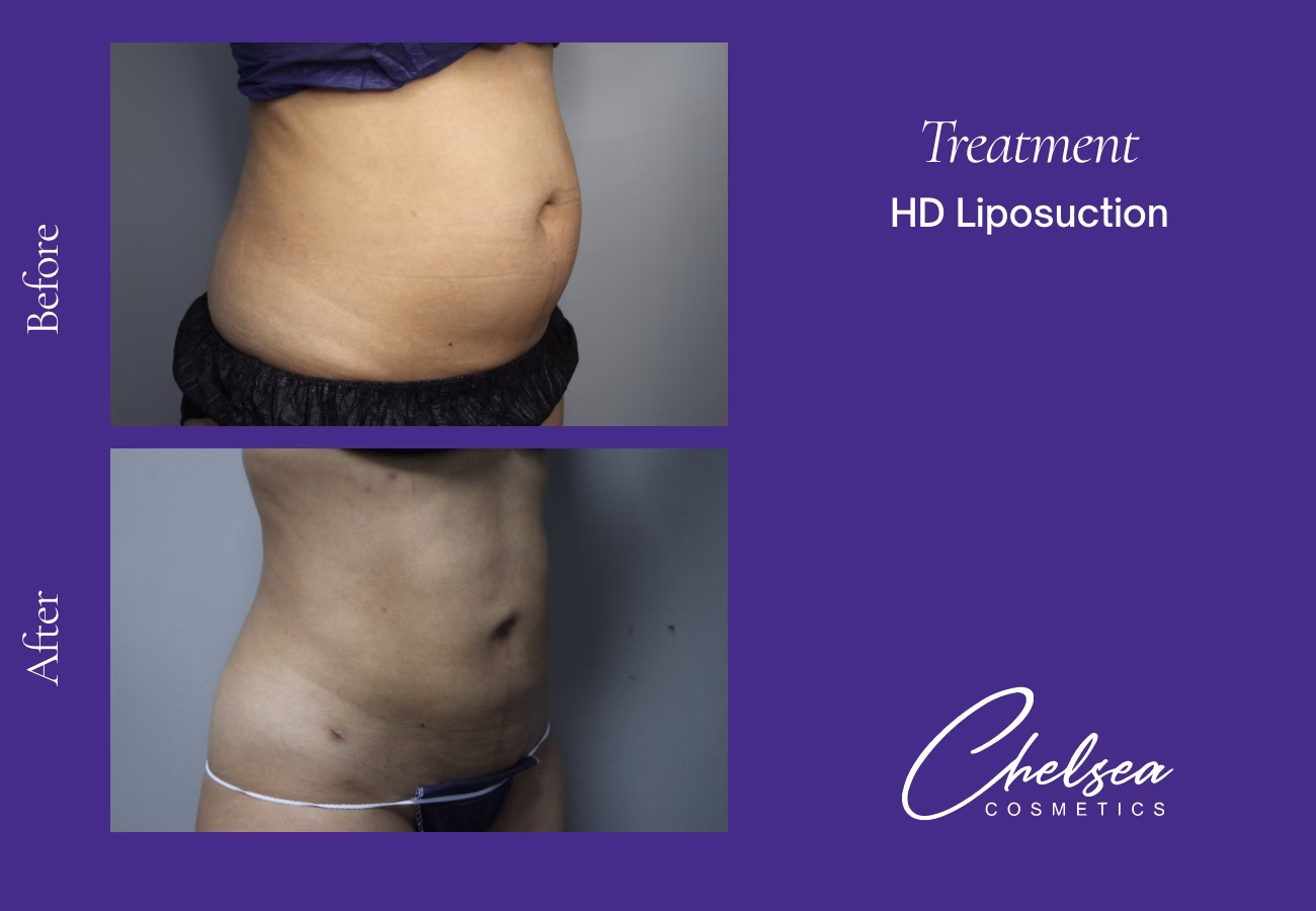 Hd abdomen female — Chelsea Cosmetics Melbourne