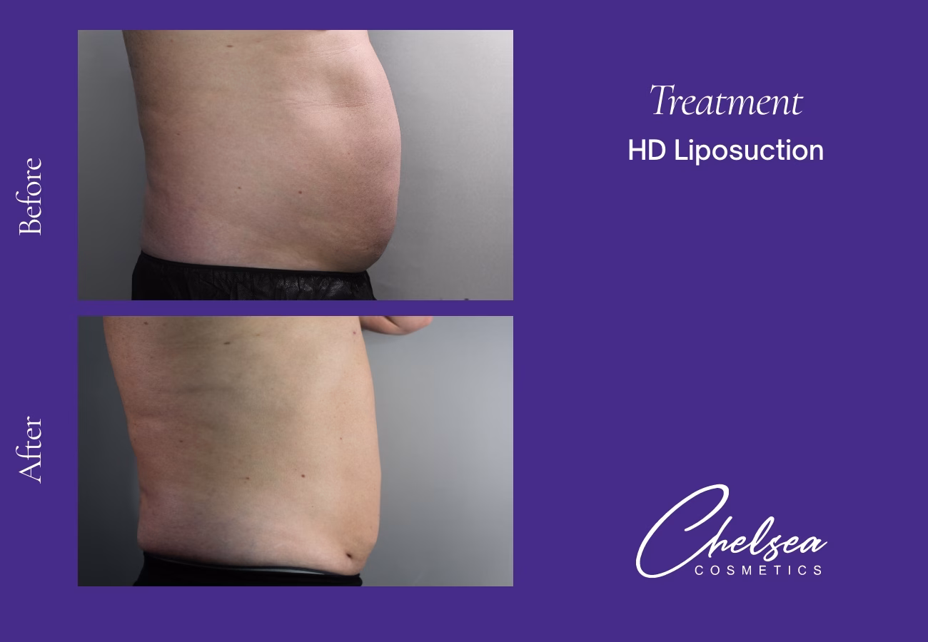Hd abdomen right — Chelsea Cosmetics Melbourne