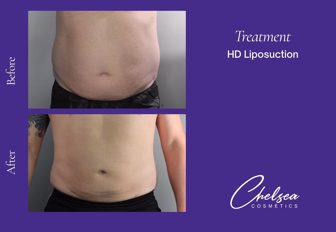 Hd abdomen — Chelsea Cosmetics Melbourne
