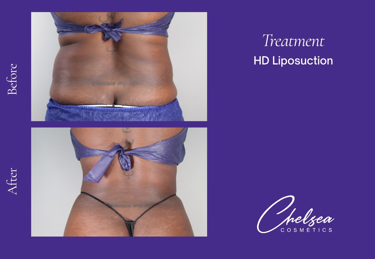 Liposuction before and after results — Chelsea Cosmetics Melbourne