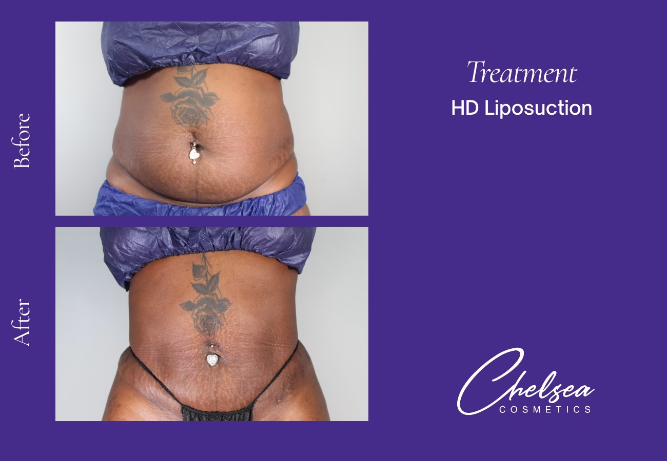 Liposuction — Chelsea Cosmetics Melbourne