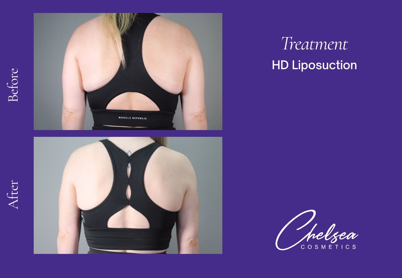 Hd lg under arms — Chelsea Cosmetics Melbourne