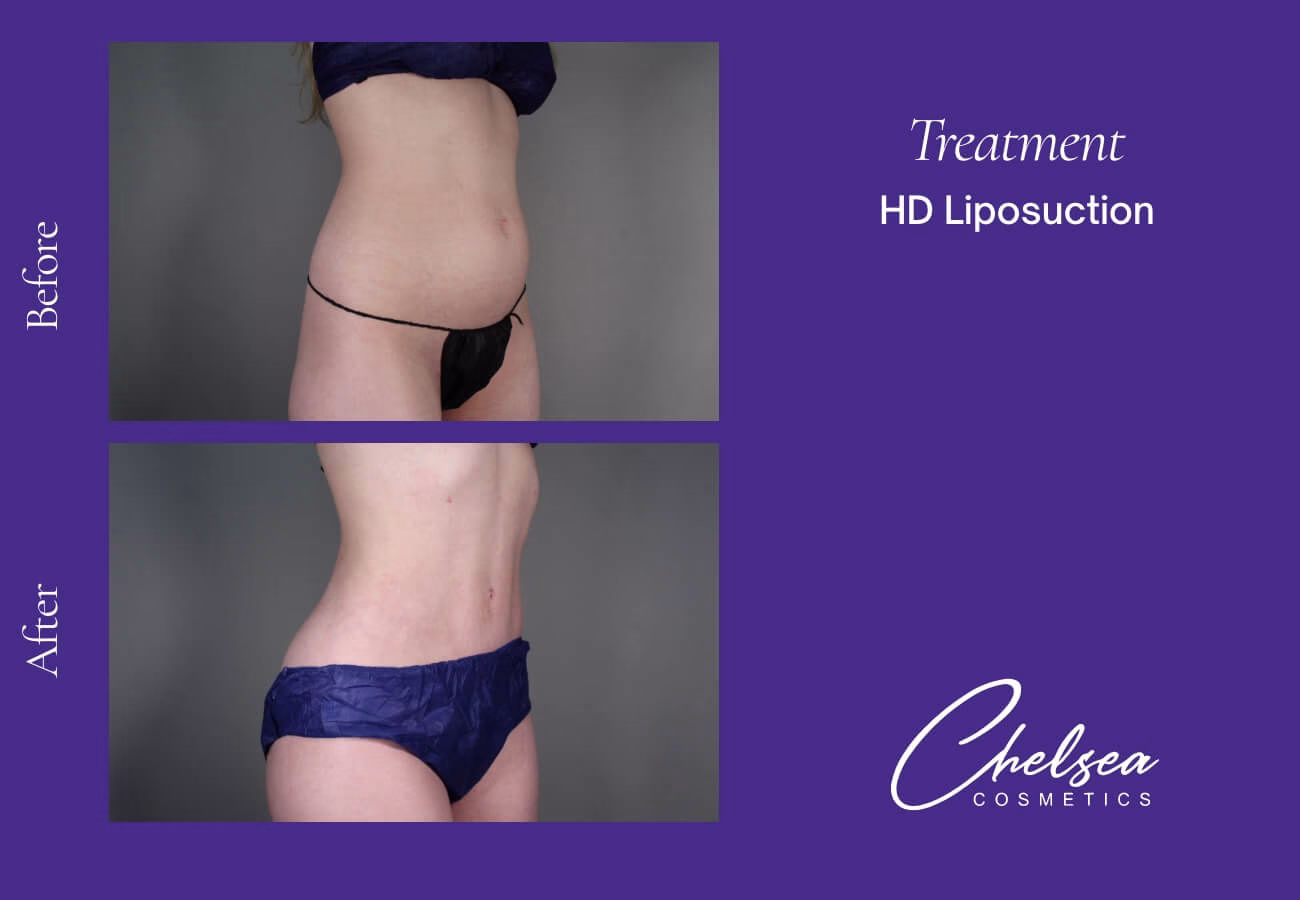 Liposuction — Chelsea Cosmetics Melbourne