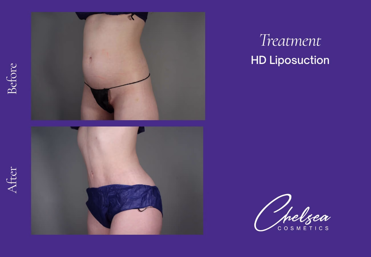 Liposuction — Chelsea Cosmetics Melbourne