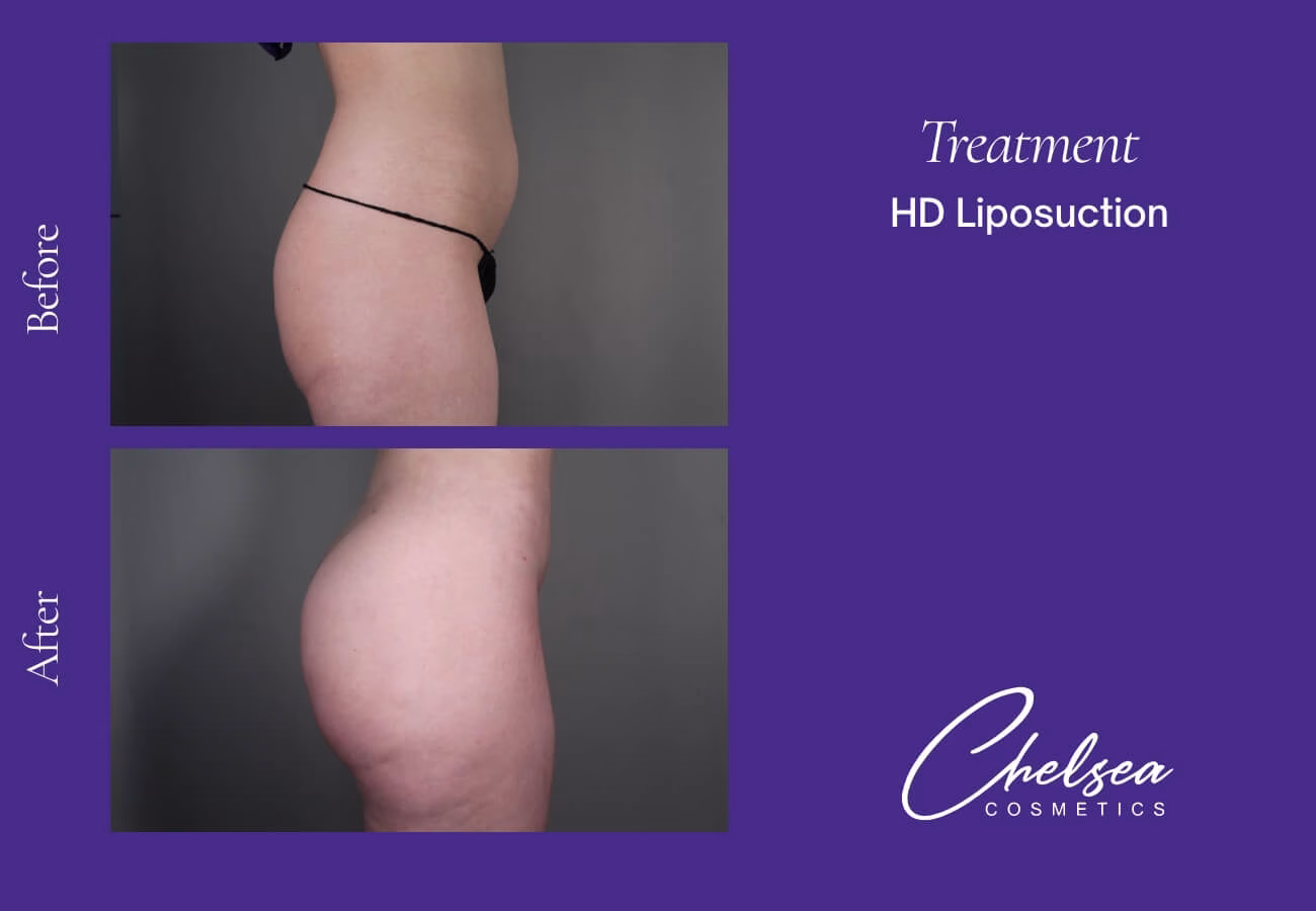 Liposuction — Chelsea Cosmetics Melbourne