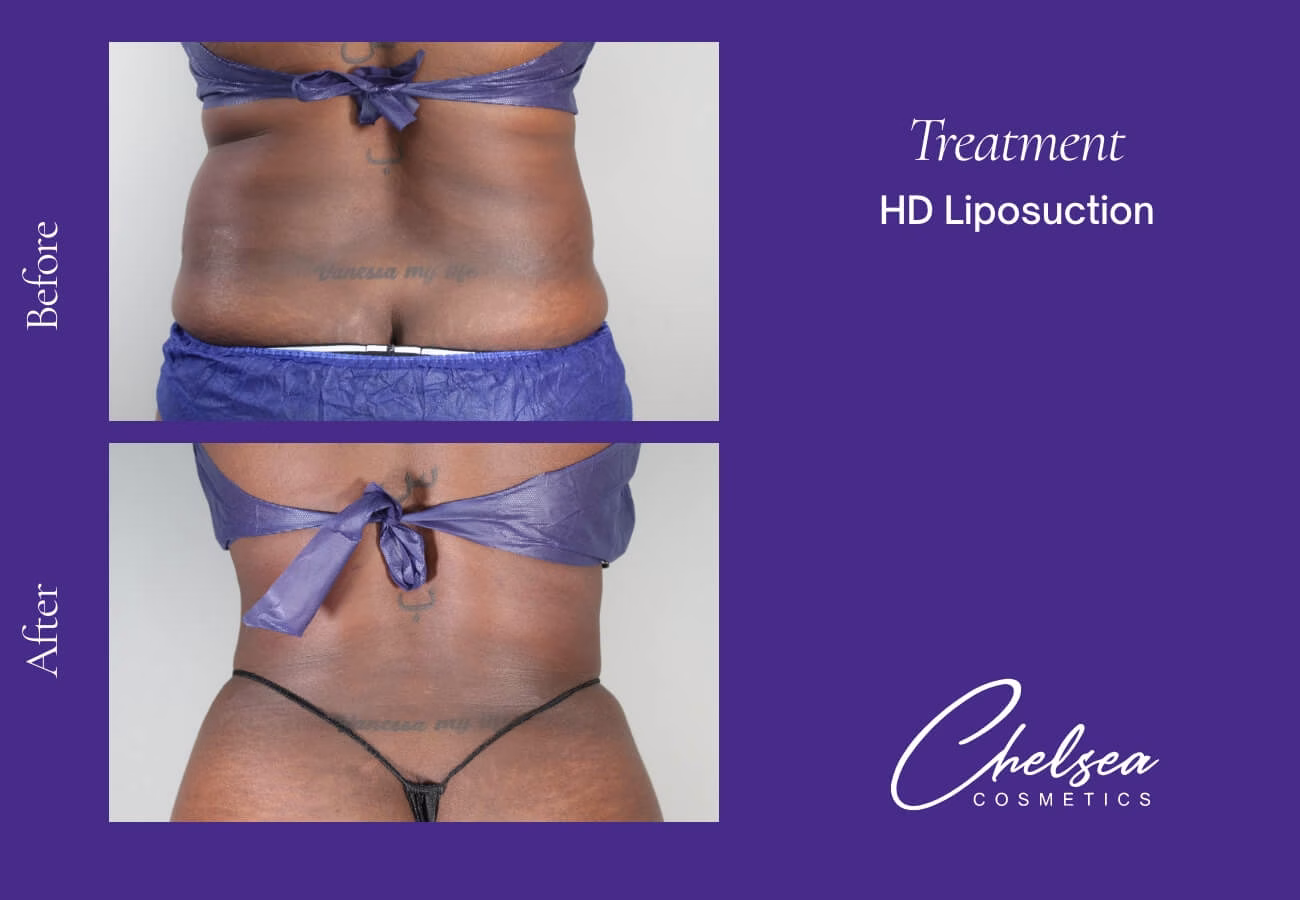 Liposuction — Chelsea Cosmetics Melbourne