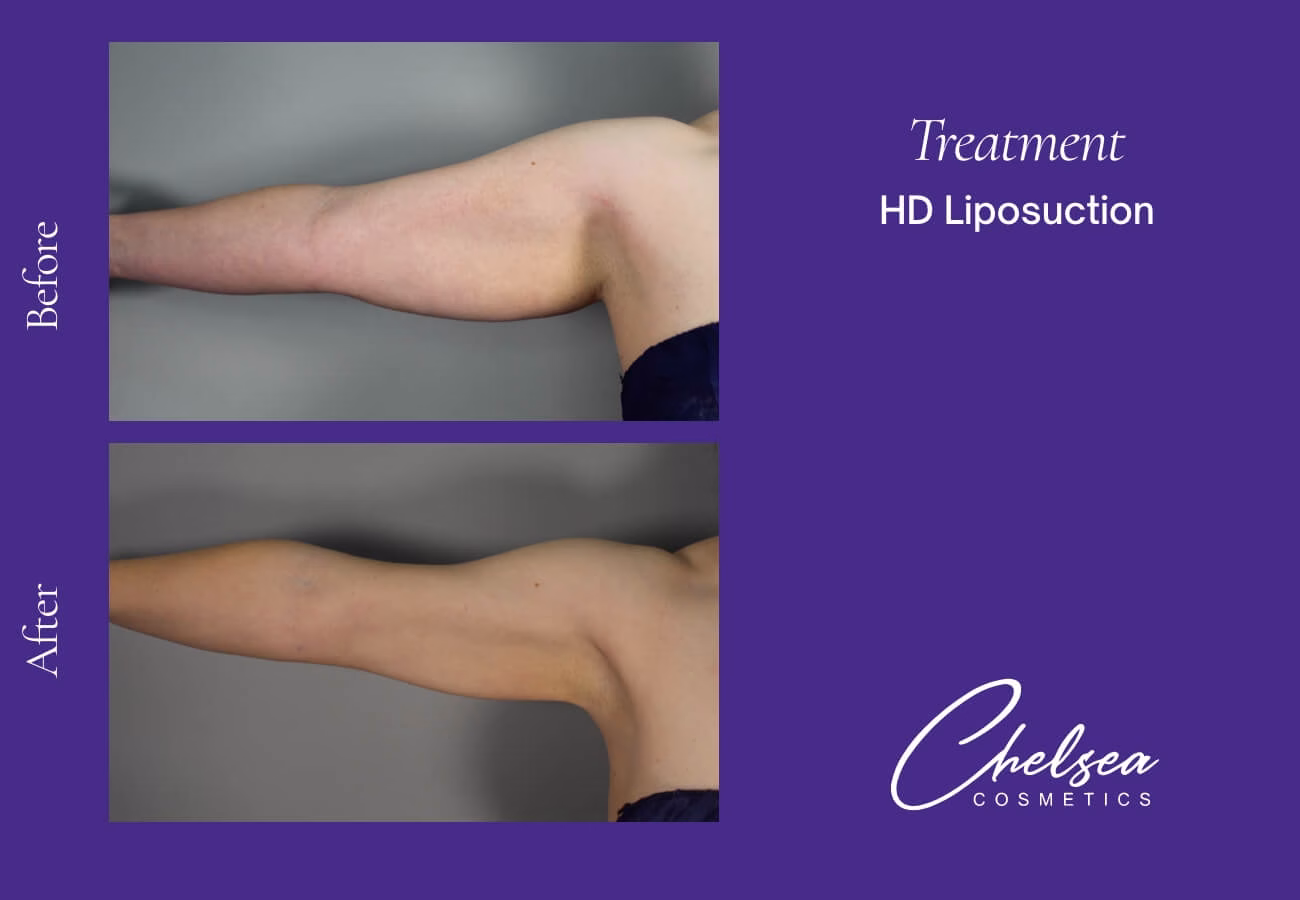 Liposuction — Chelsea Cosmetics Melbourne