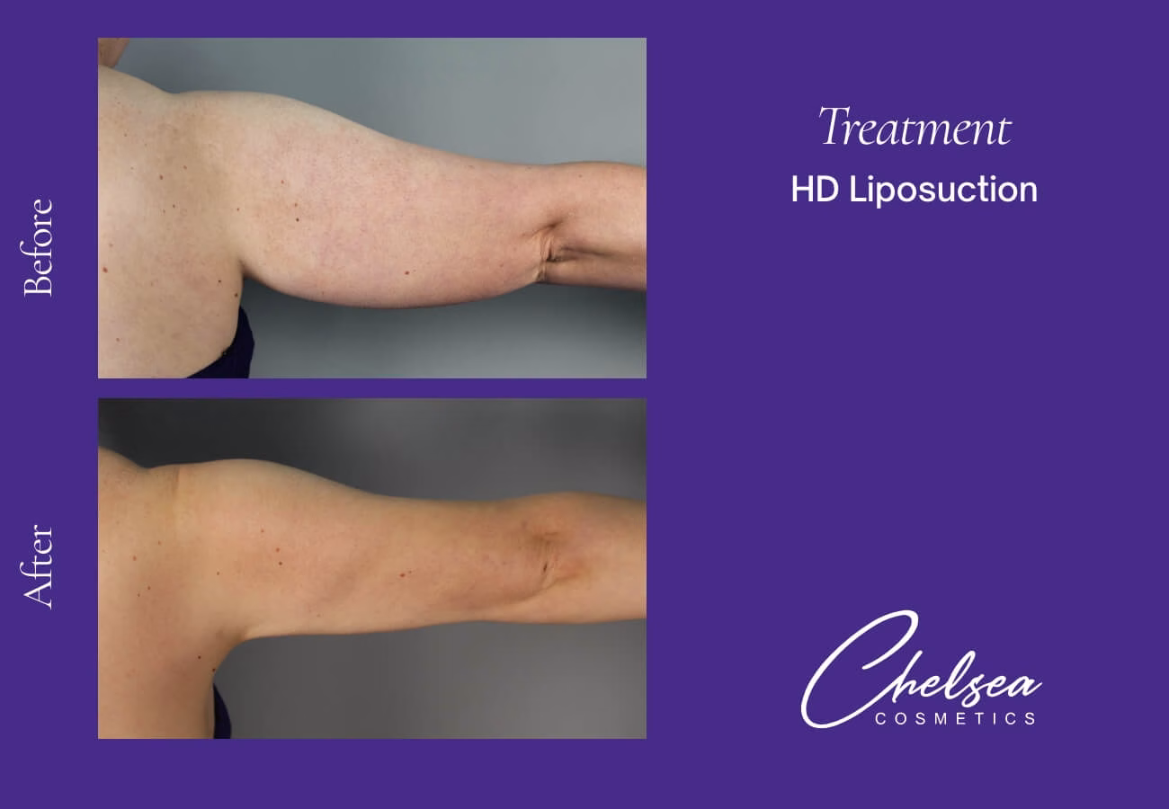 Liposuction — Chelsea Cosmetics Melbourne