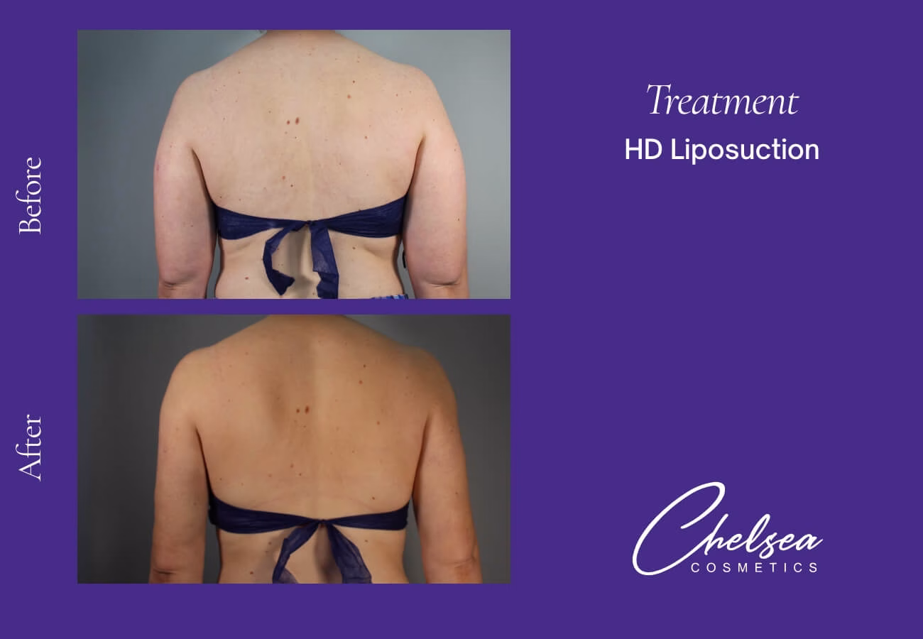 Liposuction — Chelsea Cosmetics Melbourne