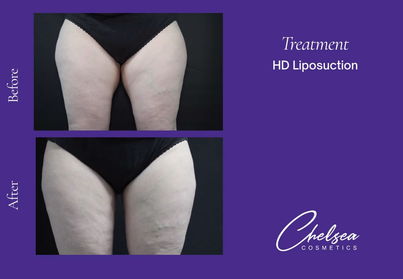 Liposuction — Chelsea Cosmetics Melbourne