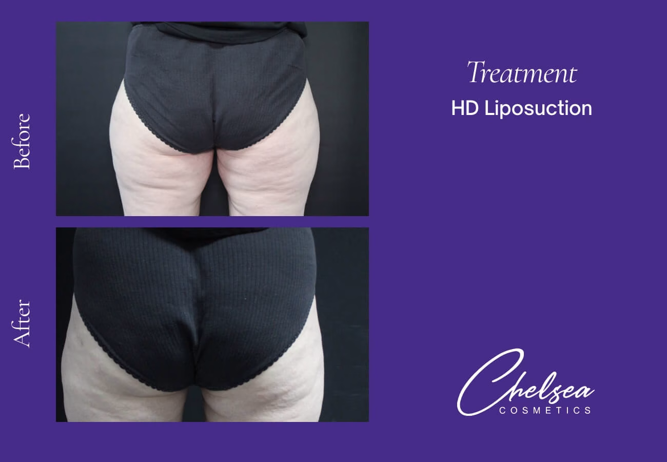 Liposuction — Chelsea Cosmetics Melbourne