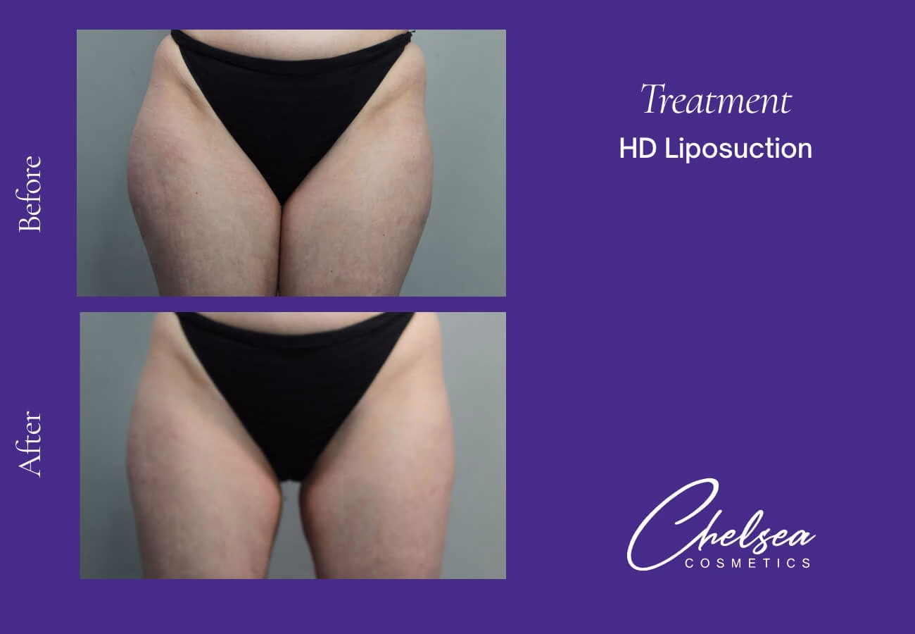 Liposuction — Chelsea Cosmetics Melbourne