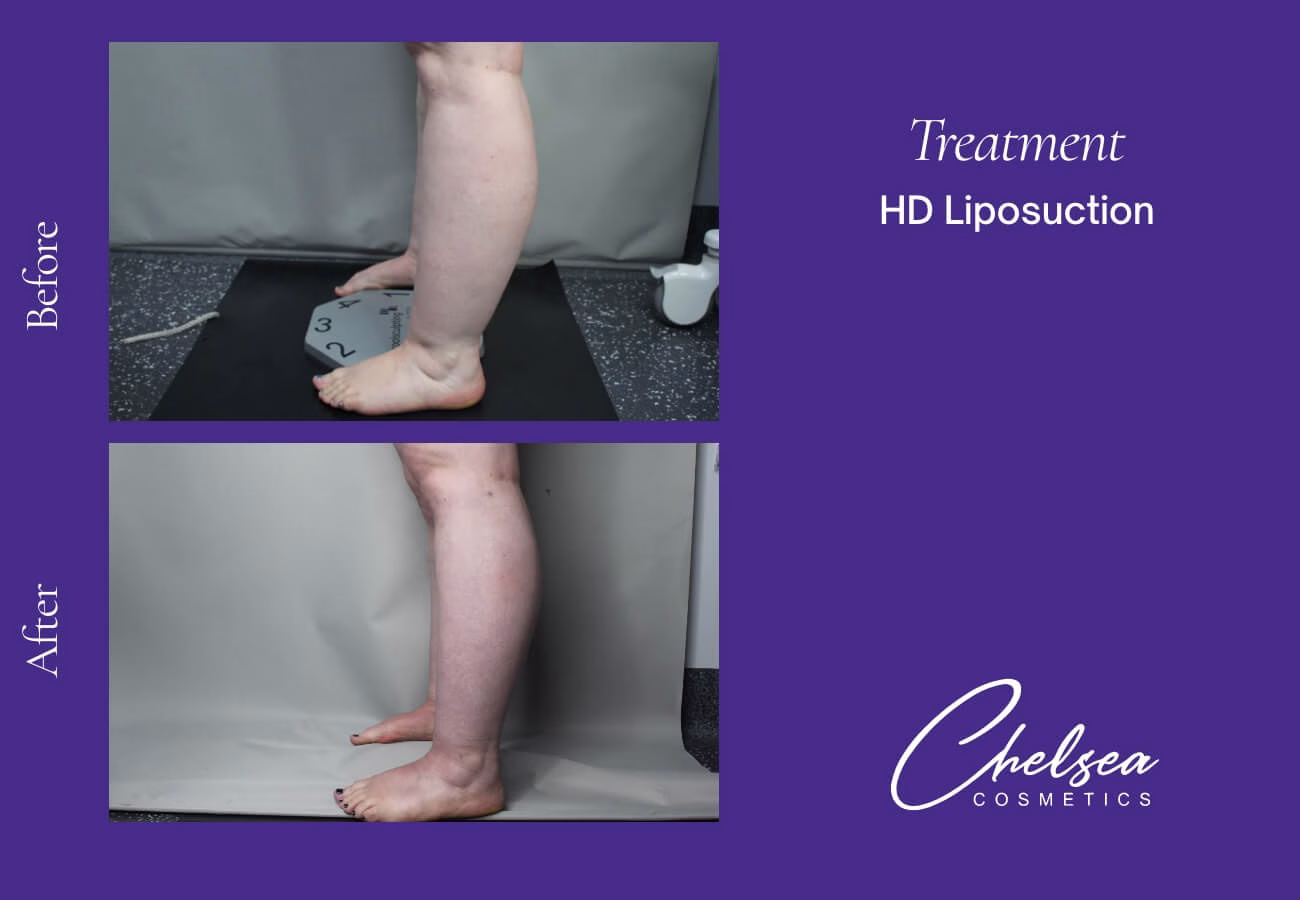 Liposuction — Chelsea Cosmetics Melbourne