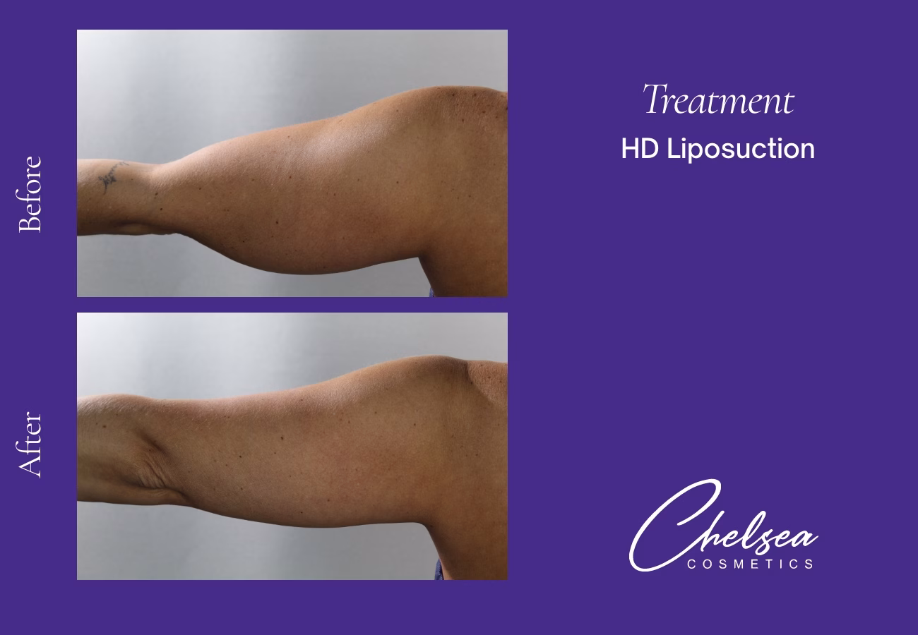 Liposuction — Chelsea Cosmetics Melbourne