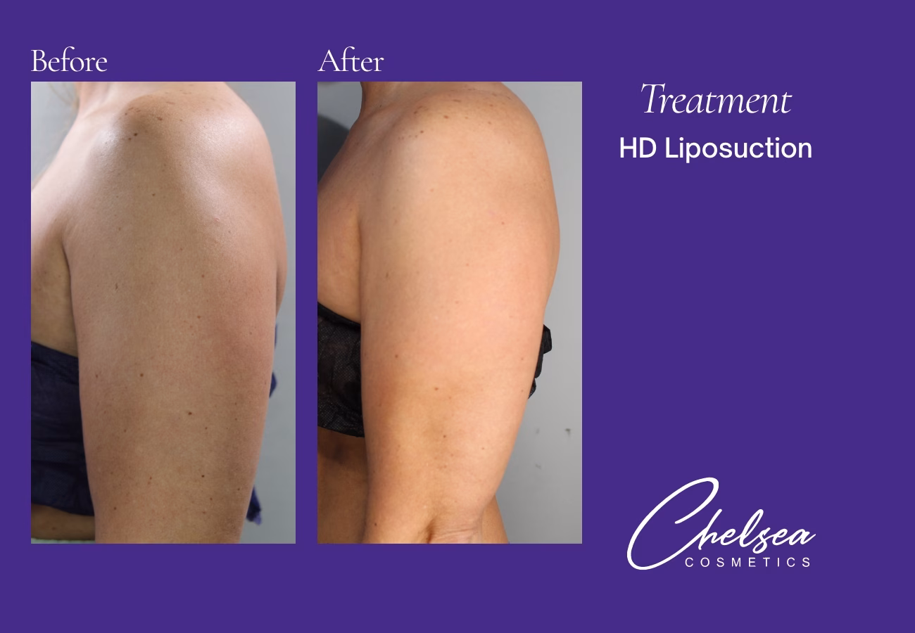 Liposuction — Chelsea Cosmetics Melbourne