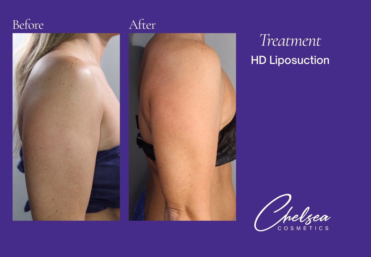 Liposuction — Chelsea Cosmetics Melbourne