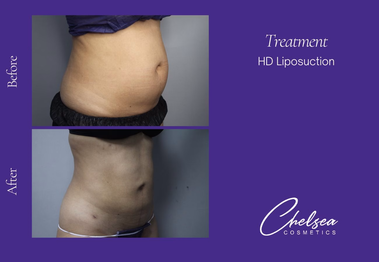Liposuction before and after results — Chelsea Cosmetics Melbourne