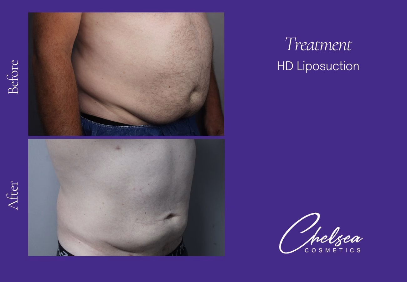 Liposuction before and after results — Chelsea Cosmetics Melbourne
