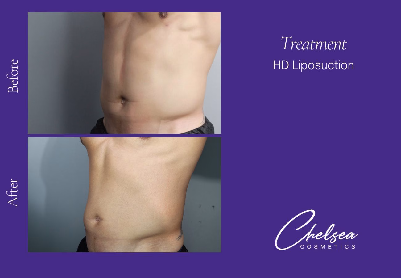 Liposuction before and after results — Chelsea Cosmetics Melbourne