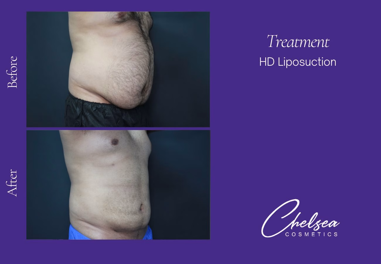 Liposuction before and after results — Chelsea Cosmetics Melbourne