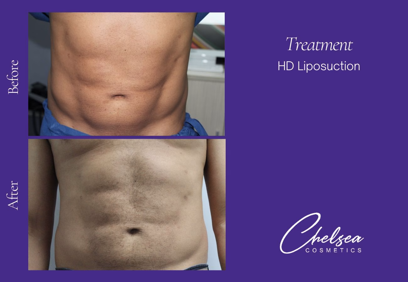 Liposuction before and after results — Chelsea Cosmetics Melbourne